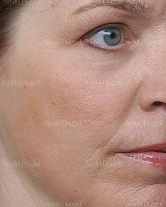 Laser Skin Resurfacing after, case 2981