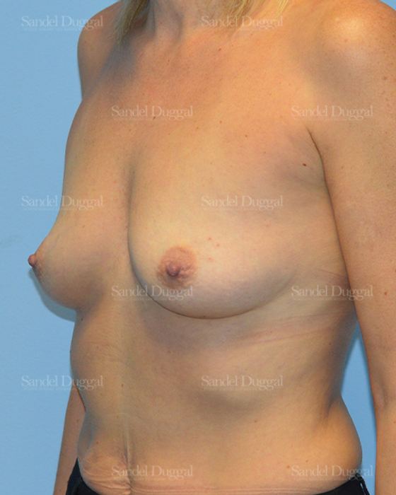 Breast Augmentation before, case 3262