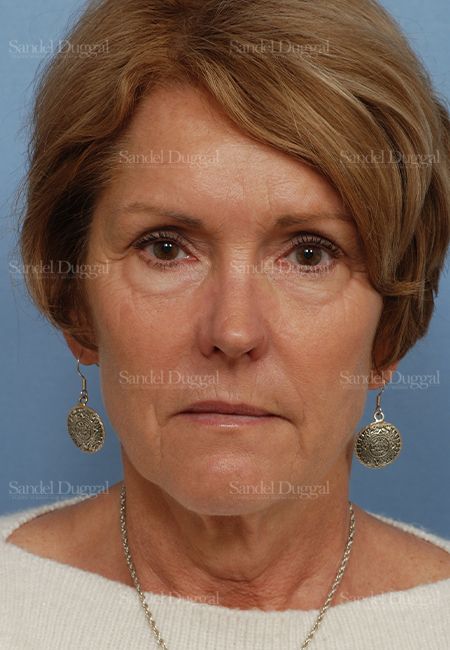 Facelift before, case 2697