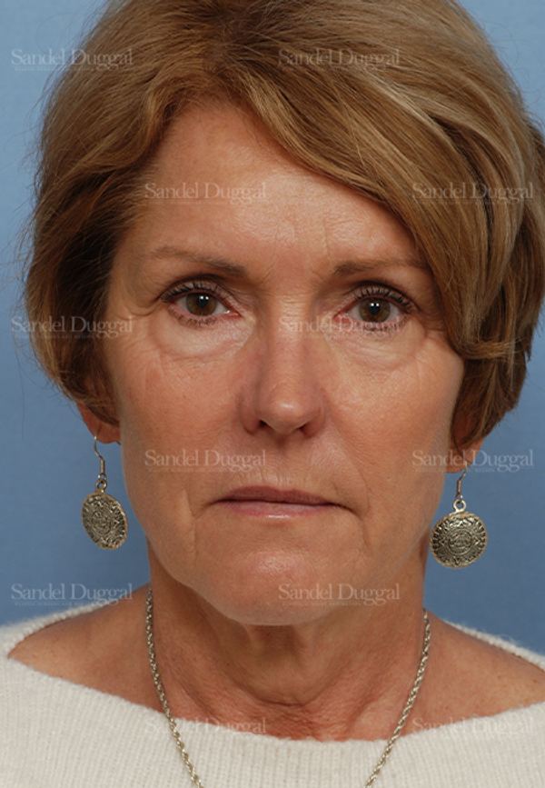 Facelift before, case 2697