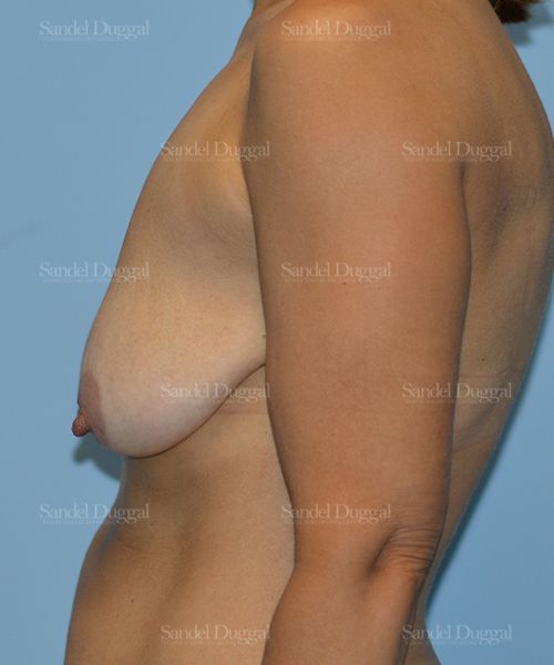 Breast Lift before, case 3329