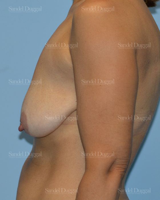Breast Lift before, case 3329