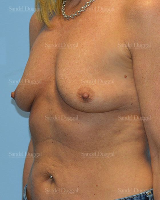 Breast Augmentation with Lift before, case 3386