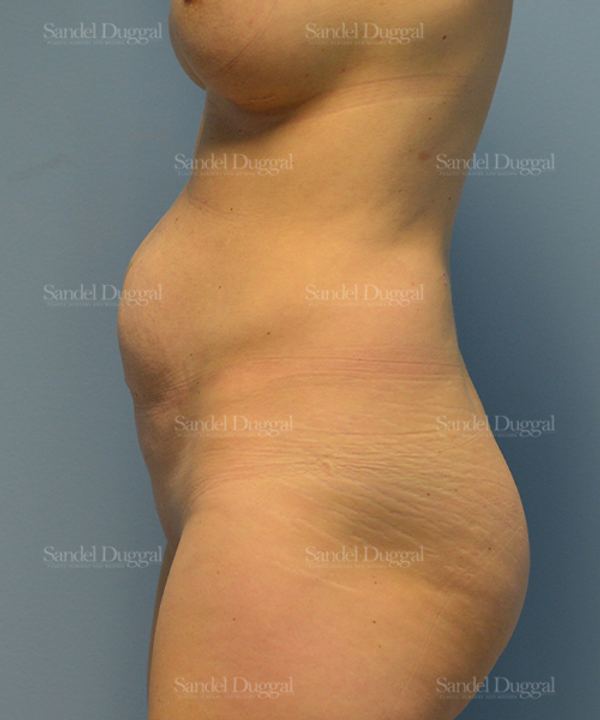 Tummy Tuck before, case 1540