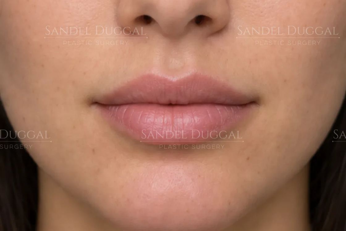 Lip Filler after, case 6014