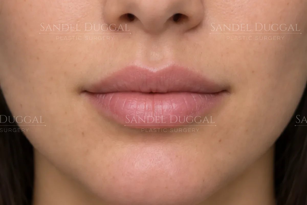 Younger patient's lips after lip filler with Restylane Silk placed within the body of the lip