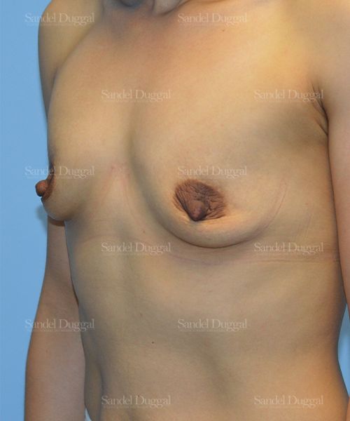 Breast Augmentation before, case 3255