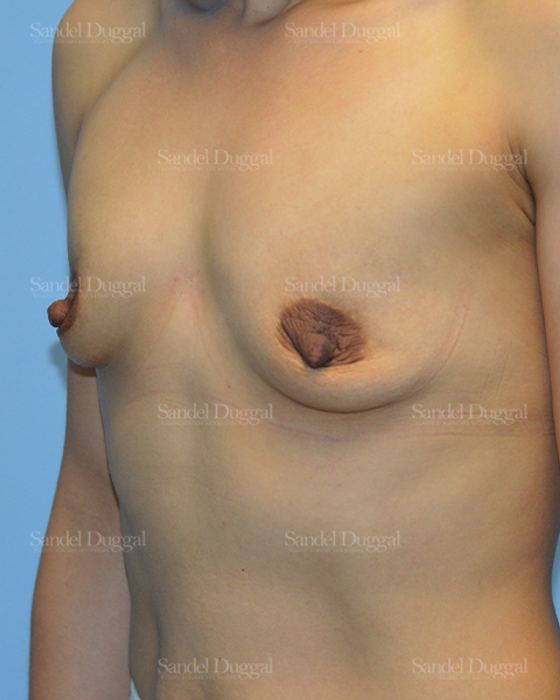 Breast Augmentation before, case 3255