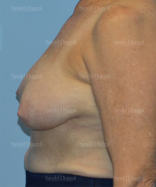 Breast Lift before, case 3315
