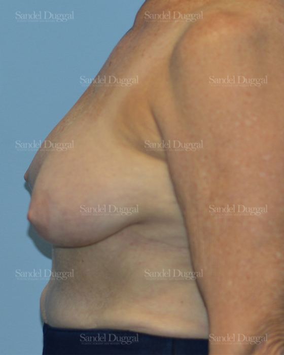 Breast Lift before, case 3315