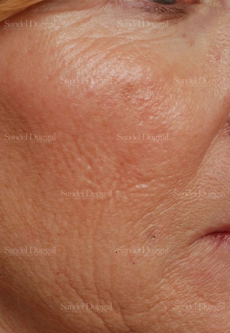 Laser Skin Resurfacing before, case 2929