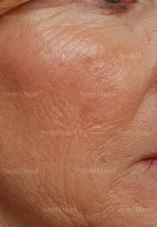 Laser Skin Resurfacing before, case 2929