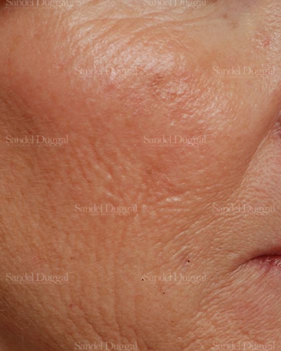 Laser Skin Resurfacing before, case 2929
