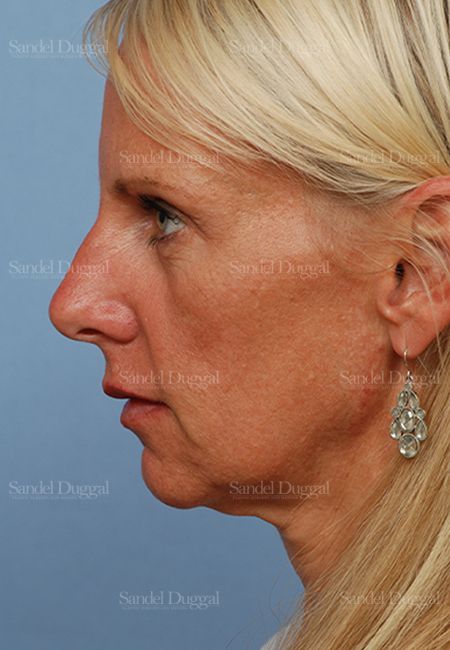 Mini Facelift before, case 2576