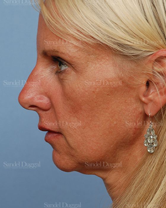Mini Facelift before, case 2576