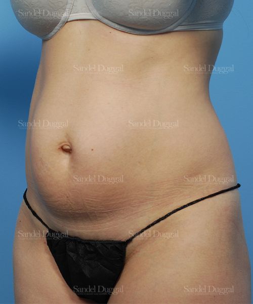 Liposuction — Abdomen before, case 2474