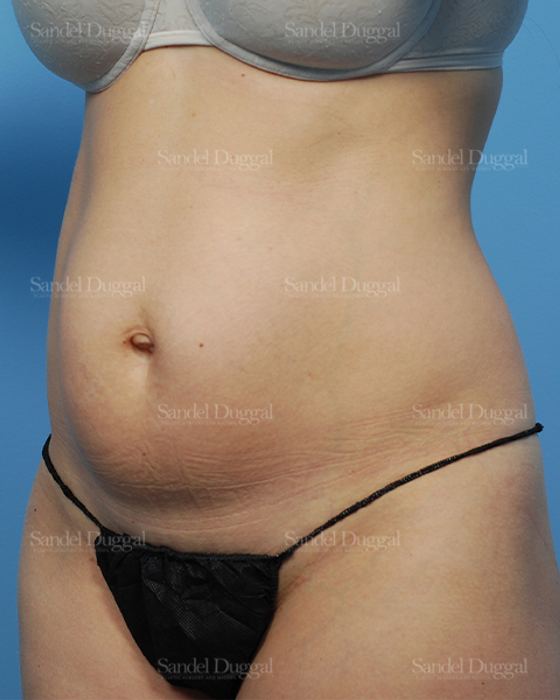 Liposuction — Abdomen before, case 2474