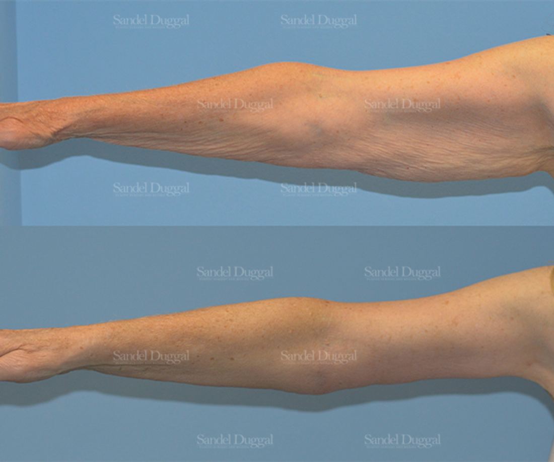 Brachioplasty before and after, case 2118