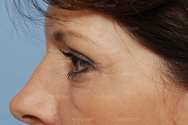 Eyelid Rejuvenation after, case 1960
