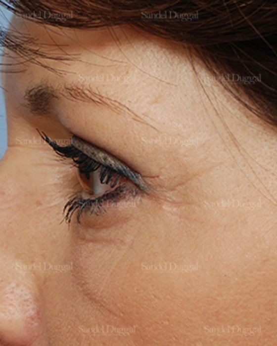 Eyelid Rejuvenation after, case 1960