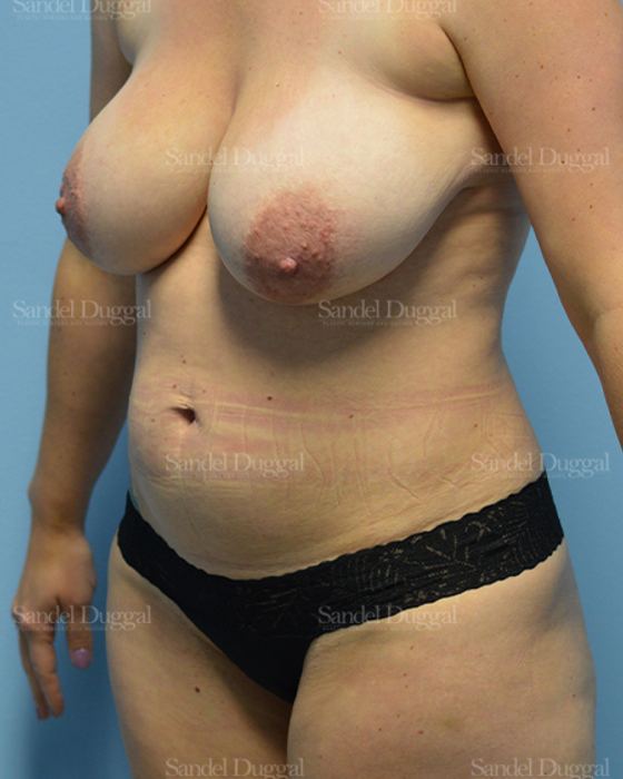 Mommy Makeover before, case 2169