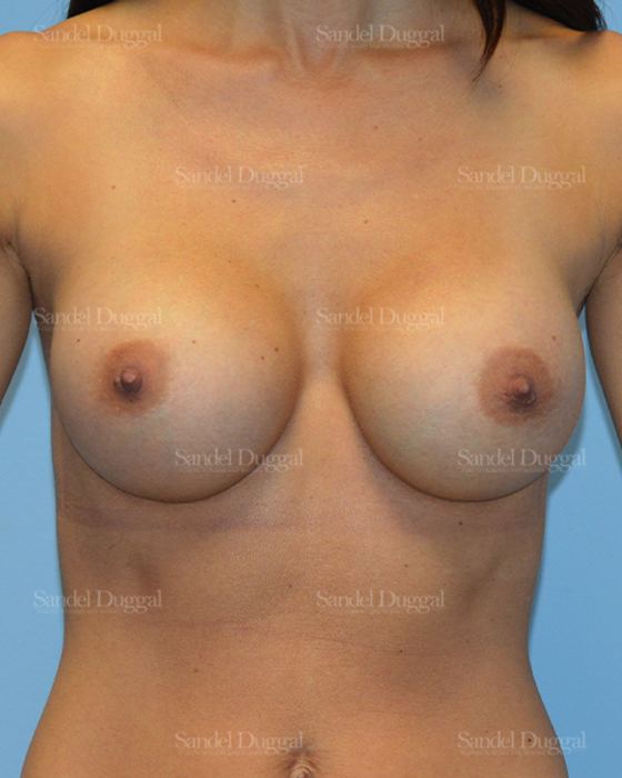 Breast Augmentation after, case 3227