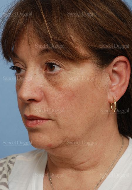 Facelift before, case 813