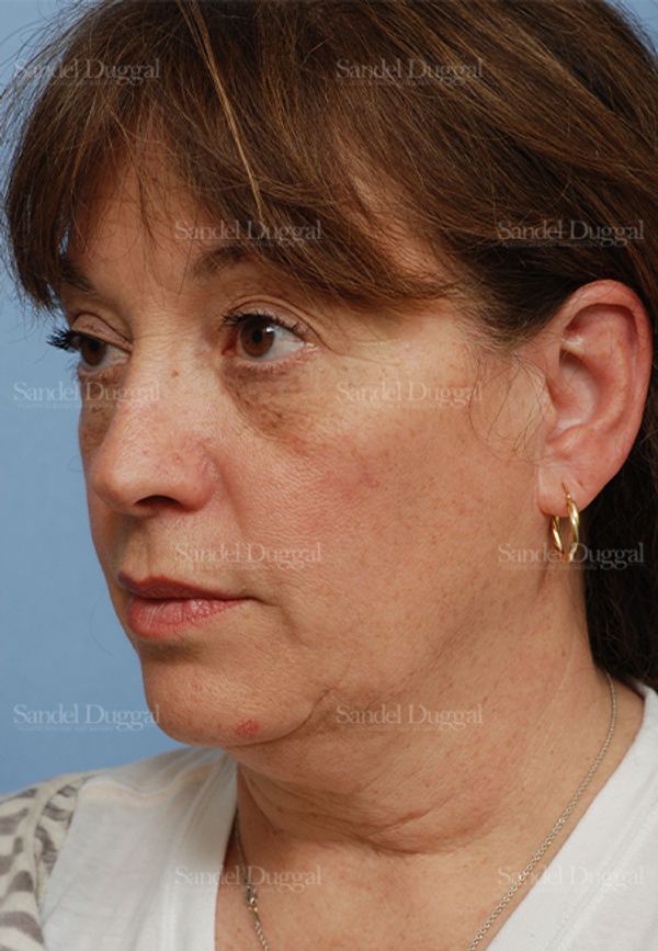 Facelift before, case 813