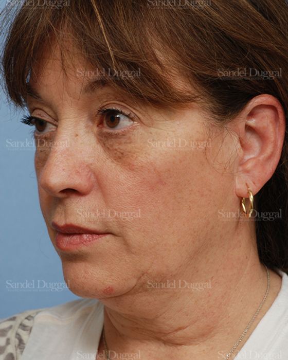 Facelift before, case 813