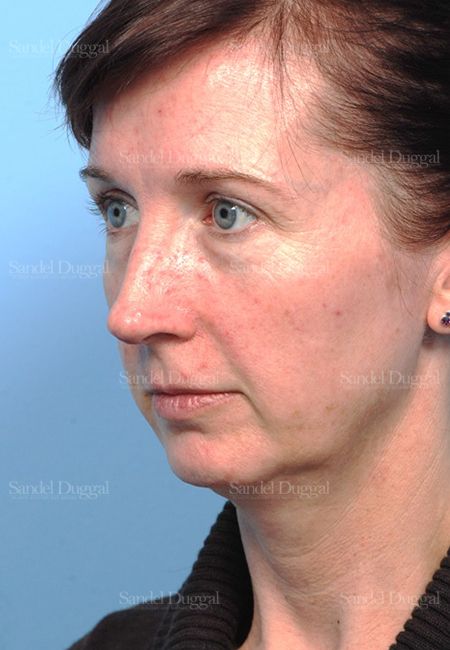 Facelift before, case 2647