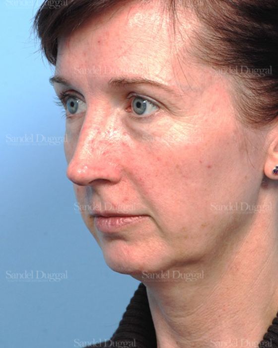 Facelift before, case 2647