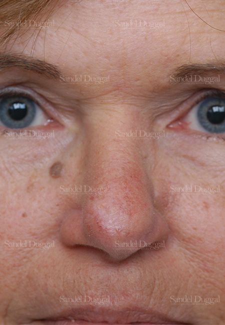 Reconstruction after Mohs after, case 2796