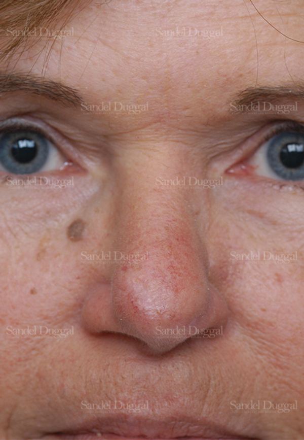 Reconstruction after Mohs after, case 2796