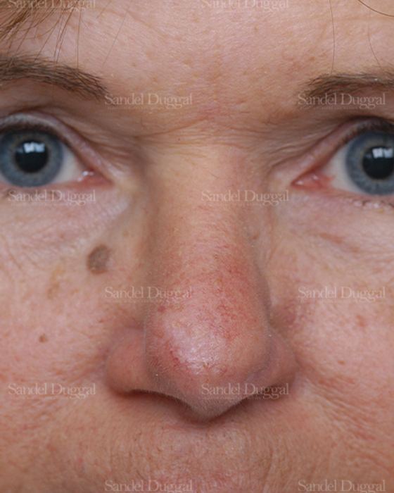 Reconstruction after Mohs after, case 2796