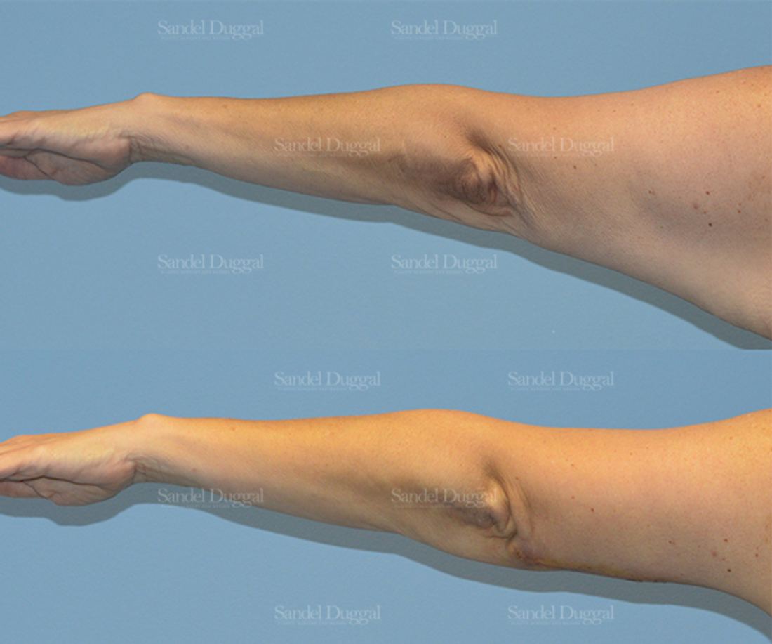 Brachioplasty before and after, case 2123