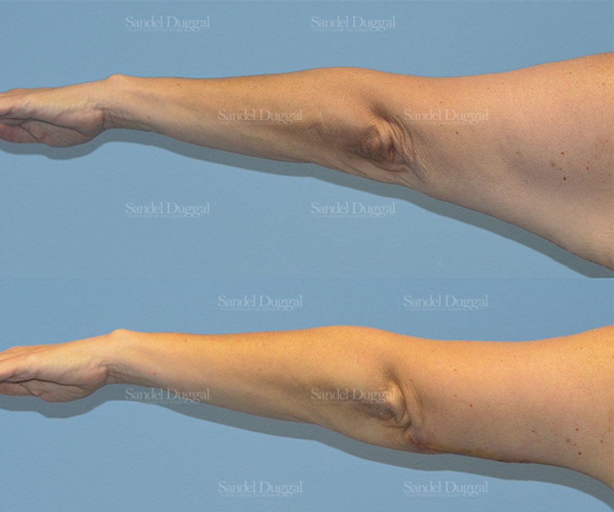 Brachioplasty before and after, case 2123