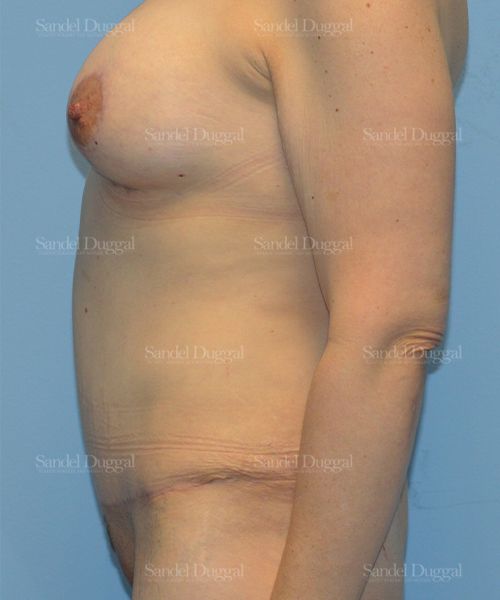 Tummy Tuck after, case 1615