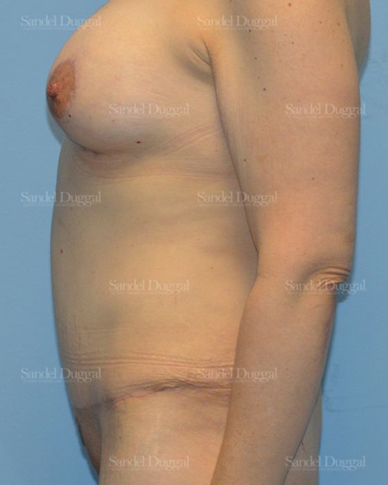 Tummy Tuck after, case 1615