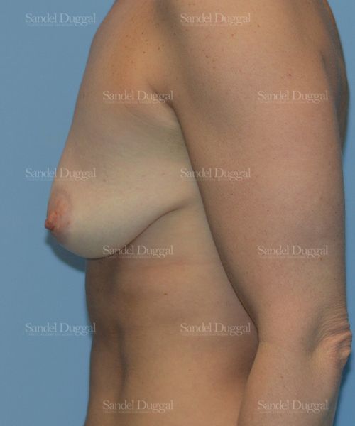 Breast Augmentation with Lift before, case 3393