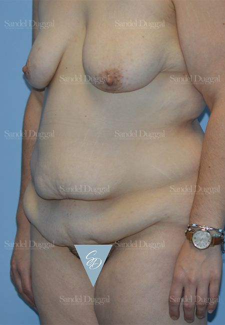 Mommy Makeover before, case 2183