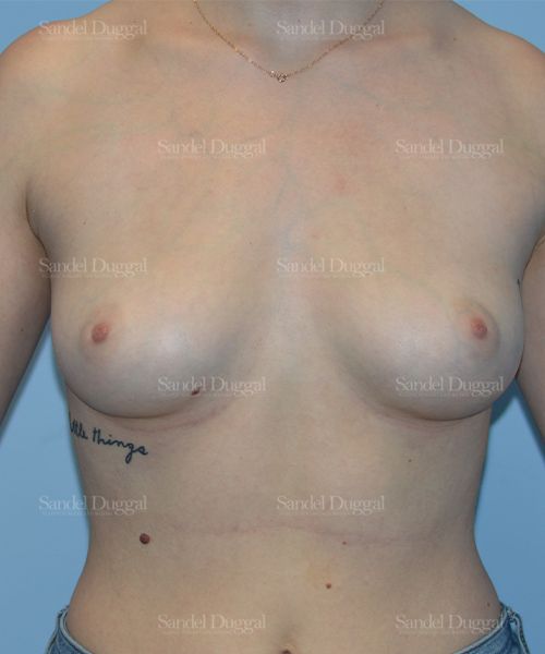 Breast Augmentation before, case 3129