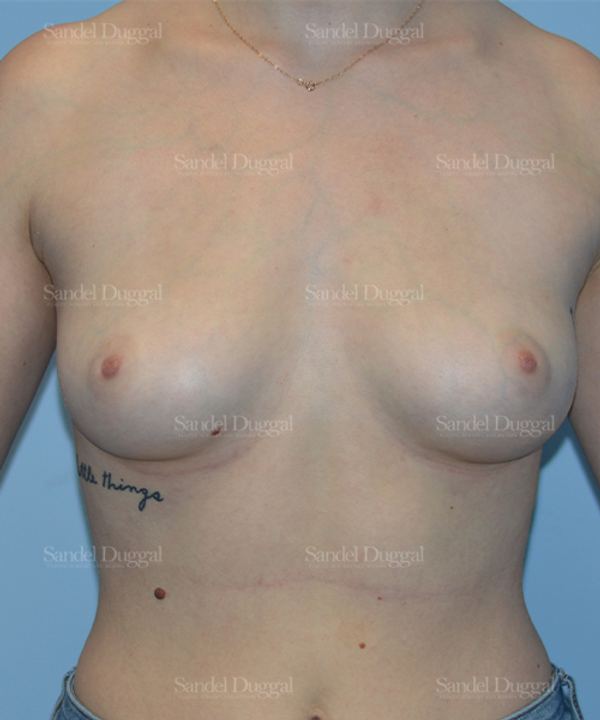 Breast Augmentation before, case 3129