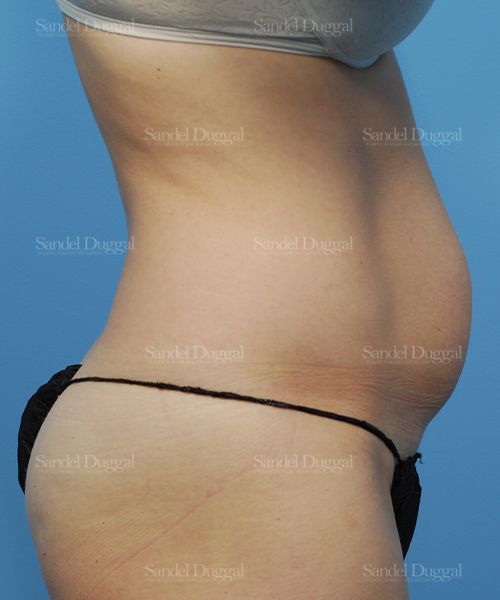 Liposuction — Abdomen before, case 2479