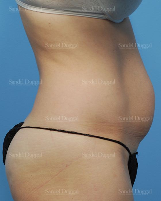 Liposuction — Abdomen before, case 2479