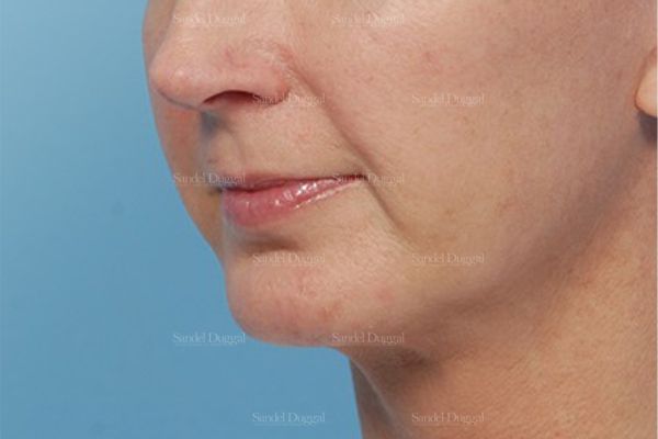 Chin Augmentation after, case 1479