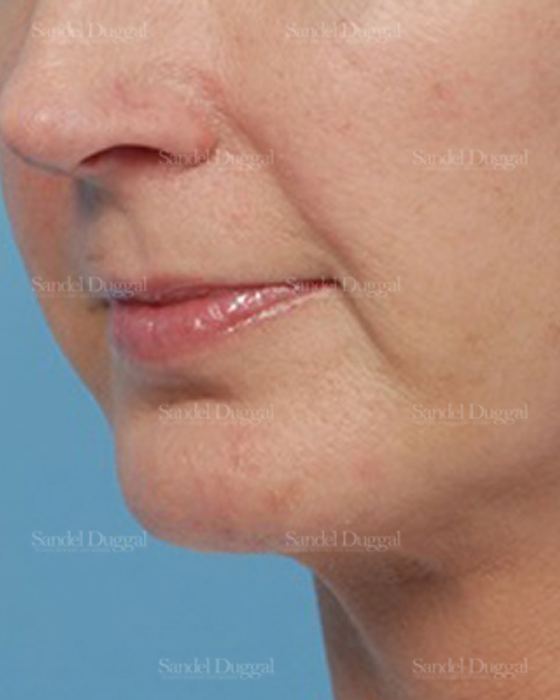 Chin Augmentation after, case 1479