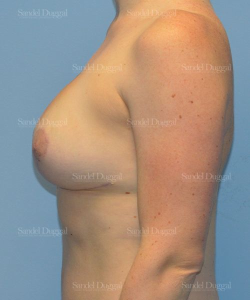 Breast Augmentation with Lift after, case 3428