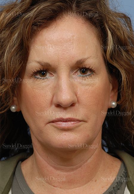 Facelift before, case 2685