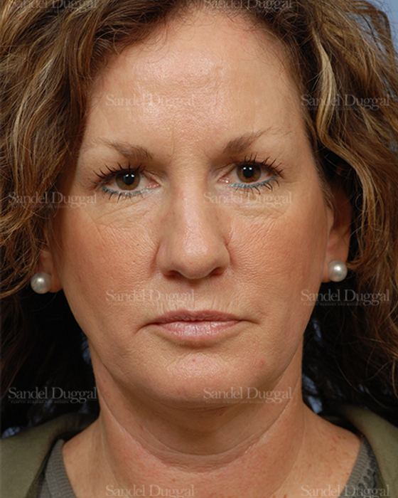 Facelift before, case 2685
