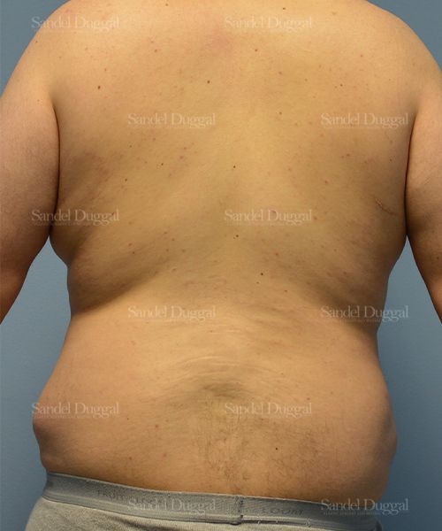 Liposuction — Legs & Flanks before, case 2545